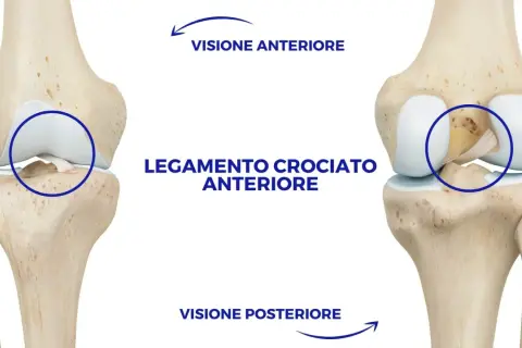 Illustrazione anatomica del ginocchio che mostra il legamento crociato anteriore. Visione anteriore e posteriore per il recupero legamento crociato anteriore senza intervento.