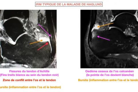 IRM montrant la maladie de Haglund : fissures du tendon d'Achille, conflit os-tendon et bursite.
