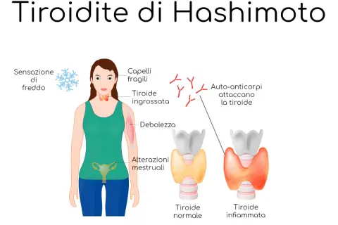 Illustrazione della tiroidite di Hashimoto: sintomi come freddo, capelli fragili, debolezza, alterazioni mestruali e auto-anticorpi che attaccano la tiroide, confrontando una tiroide normale con una infiammata.