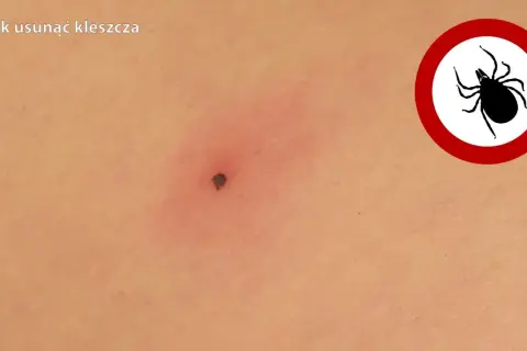 Jak bezpiecznie usunąć nimfę kleszcza? Szybki poradnik krok po kroku