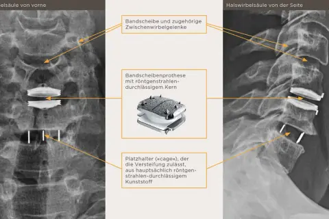 Röntgenbilder der Halswirbelsäule zeigen eine Bandscheibenprothese mit einem röntgendurchlässigen Kern und einem Platzhalter ("cage") für die hws versteifung.