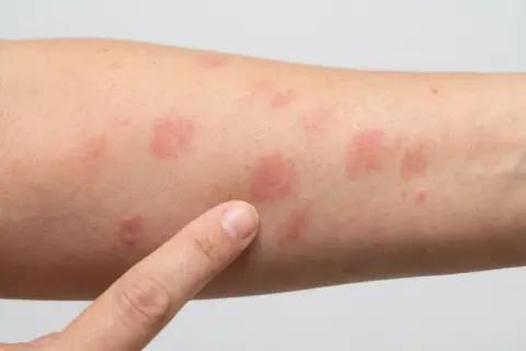 Ein Finger zeigt auf einen Arm mit mehreren kreisrunden roten Flecken auf der Haut. Mögliche Anzeichen für Hautkrebs oder andere Hautirritationen.