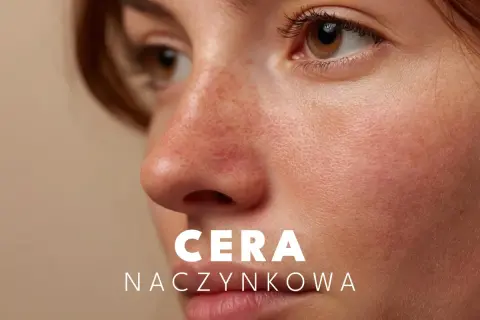 Delikatna skóra z widocznymi naczynkami. Dowiedz się, jak dbać o cerę naczynkową, by była zdrowa i promienna.