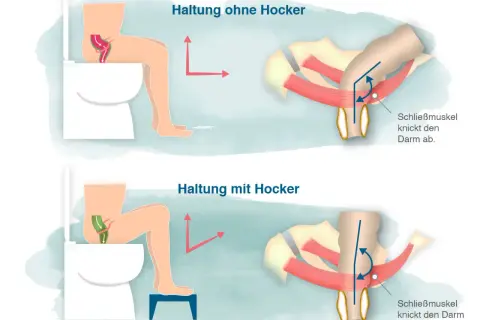 Hockstellung auf Toilette mit Hocker erleichtert den stuhlgang anregen, da der Darm gerade bleibt. Ohne Hocker wird der Darm abgeknickt.