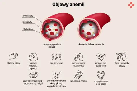 Ilustracja pokazuje naczynie krwionośne z normalnym poziomem żelaza i naczynie z niedoborem żelaza, co prowadzi do anemii. Objawy anemii to m.in. bladość skóry, spadek energii, bóle głowy.
