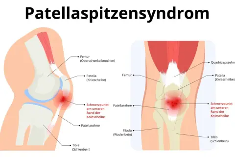 Illustration des Knies mit Hervorhebung des Schmerzpunktes an der Patellasehne, typisch für Patellaspitzensyndrom.
