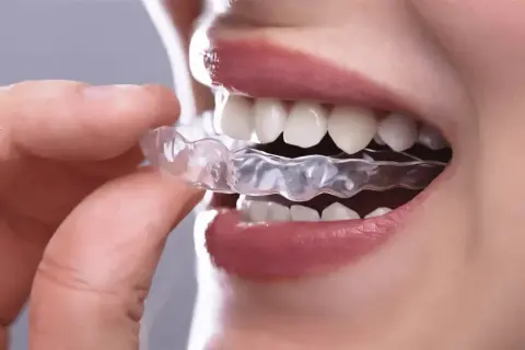 Dita inseriscono un bite dentale trasparente per rilassare la muscolatura.