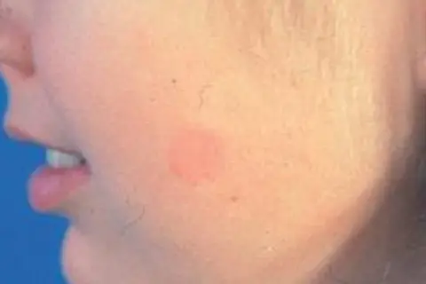 Czerwona plama na policzku, objaw grzybicy skóry twarzy.
