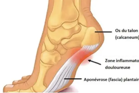 Anatomie du pied montrant l'aponévrose plantaire enflammée. Une bonne alimentation peut aider à gérer l'aponévrosite plantaire.