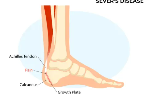Schéma du pied montrant la maladie de Sever : douleur au talon (calcanéus) due à l'inflammation de la plaque de croissance, affectant le tendon d'Achille.