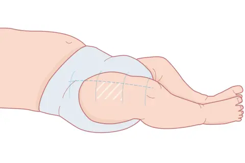 Illustration av ett barns lår med en ljusblå blöja. Markeringar på låret indikerar var 3 månaders vaccin ges.