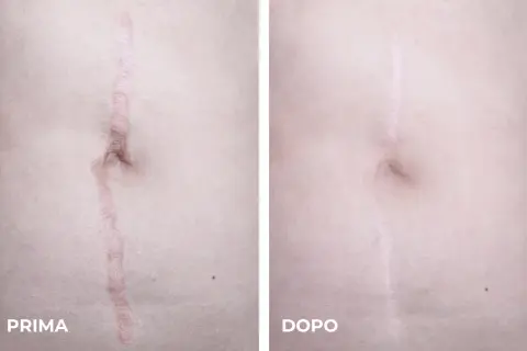 Confronto laser cicatrici prima e dopo: la cicatrice è visibilmente ridotta e meno evidente dopo il trattamento.