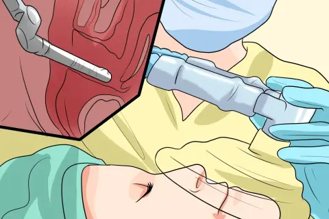 Chirurgie endoscopique pour une cystocèle grade 2. Un instrument médical est inséré dans une zone anatomique.