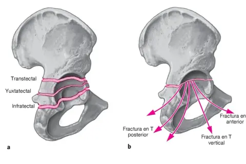 Ilustración de pelvis con fractura en rodete. A muestra tipos transtectal, yuxtatectal e infratectal. B muestra fractura en T anterior, posterior y vertical.