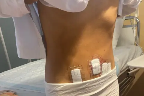 Efter operation för cysta i magen, syns plåster på ryggen.