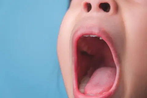 Dziecko z otwartymi ustami, język lekko zaczerwieniony, jakby miało poparzone podniebienie po gorącej zupie.