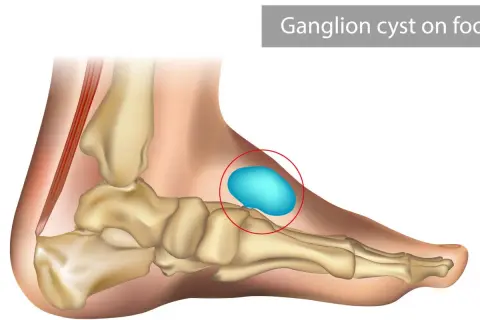 Anatomia stopy z widocznym ganglion na stopie, zaznaczonym czerwonym okręgiem.