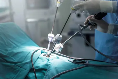 Chirurg wykonuje laparoskopię, co to jest? Precyzyjne narzędzia wprowadzane przez małe nacięcia.