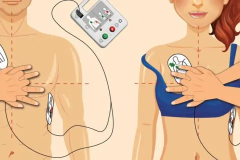 Instrukcja zakładania elektrod AED. Prawidłowe umiejscowienie elektrod jest kluczowe dla analizy rytmów do defibrylacji.