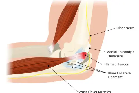 Anatomia łokcia z zapaleniem ścięgna, więzadła pobocznego łokciowego i nerwu łokciowego. Ból łokcia może być spowodowany stanem zapalnym.