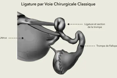 Illustration d'une ligature des trompes par voie chirurgicale classique, montrant l'utérus et une trompe de Fallope ligaturée et sectionnée.