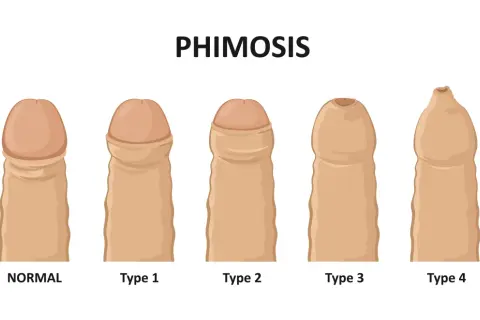 Różne stopnie stulejki (phimosis): od normalnego, przez typ 1, 2, 3, aż po typ 4, gdzie napletek jest mocno zwężony.