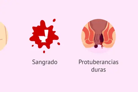 Síntomas de hemorroides postparto: picor, sangrado, protuberancias duras y dolor al defecar.
