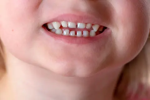 Primo piano di un sorriso di bambino con un diastema tra i denti inferiori, che mostra i denti da latte.