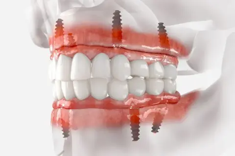 Model szczęki z implantami zygomatycznymi, pokazujący mocowanie protezy na implantach.