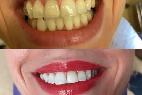 Wybielanie zębów u dentysty: Koszt, efekty i bezpieczeństwo. Poznaj fakty.