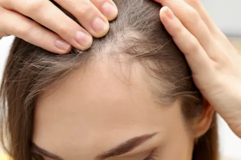 Dłonie kobiety dotykają jej głowy, sprawdzając przerzedzone włosy. Widać delikatne, cienkie baby hair przy linii czoła.