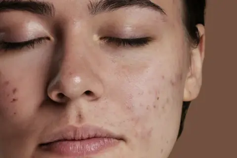 Primo piano del viso di una giovane donna con diversi tipi di imperfezioni viso, tra cui brufoli e macchie rosse.