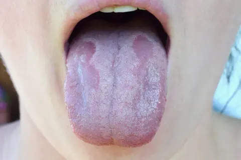 Lingua con placche biancastre, sintomo di candida orale. Si valuta l'uso di fermenti lattici per candida orale.