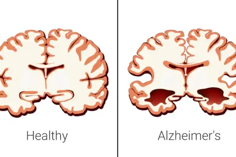 Porównanie mózgu zdrowego i z objawami choroby Alzheimera, która bywa nazywana cukrzycą typu 3. Widać zanik tkanki mózgowej.
