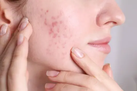 Skóra z zaczerwienieniami i wypryskami, być może objawy fungal acne. Dłonie delikatnie dotykają policzka.