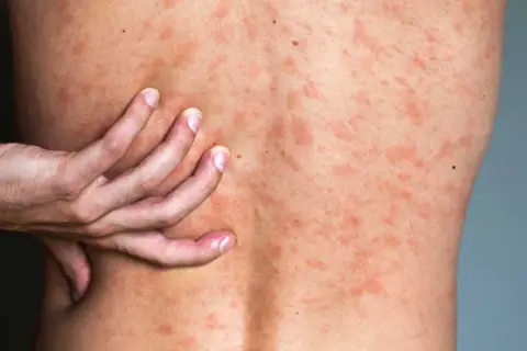 Une main gratte le dos couvert de plaques rouges, signe d'urticaire après la douche.
