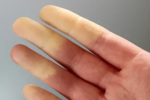 Palce dłoni z widocznymi zmianami koloru, wskazującymi na zespół Raynauda.