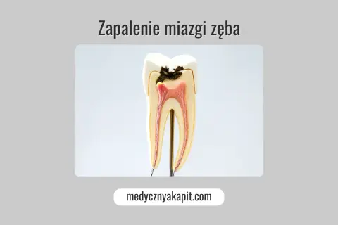 Model zęba z widocznym ubytkiem i zapaleniem miazgi. Objawy zapalenia miazgi mogą być bolesne.
