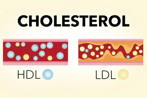 Jak obniżyć cholesterol przy izoteku i uniknąć zdrowotnych zagrożeń
