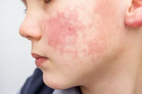 Visage d'enfant marqué par une rougeur diffuse et des plaques, symptômes d'une allergie pollen visage.