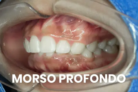 Denti bianchi e gengive rosa in un'apertura orale. Si nota un morso profondo, dove i denti superiori coprono quasi completamente quelli inferiori.