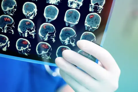 Lekarz analizuje tomografię komputerową mózgu, widoczne są liczne ogniska wskazujące na przerzuty do mózgu.
