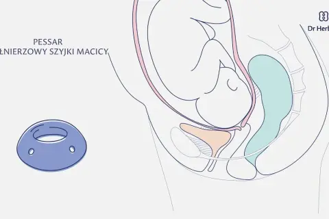 Skracanie szyjki macicy w ciąży: Jak zapobiec przedwczesnemu porodowi?