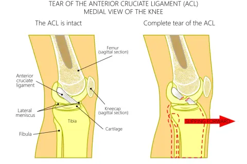 Anatomia kolana: zerwane więzadło krzyżowe przednie (ACL) powoduje przesuwanie się kości. Ltc kolano co to jest – ilustracja pokazuje uszkodzenie ACL.