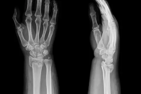 Radiographies du poignet montrant une fracture. L'image de gauche est de face, celle de droite de profil.