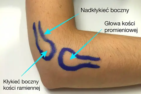 Zaznaczone niebieskim markerem okolice łokcia, wskazujące na łokieć tenisisty: nadkłykieć boczny, głowa kości promieniowej i kłykieć boczny kości ramiennej.