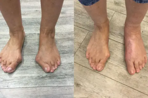 Vorher-Nachher-Vergleich von Füßen mit Hallux valgus, rechts nach Lapidus Arthrodese.