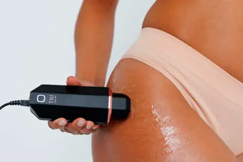 Tratamiento de radiofrecuencia para celulitis en muslo. Dispositivo de belleza en uso.