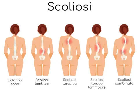 Illustrazione mostra diverse forme di scoliosi, inclusa la scoliosi lombare e toracica, evidenziando il gibbo.