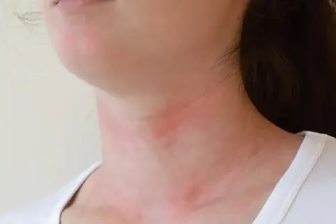 Alergia na pomidory: objawy, krzyżówki i nietolerancja histaminy